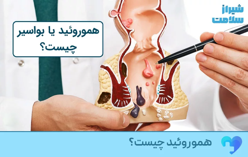 هموروئید یا بواسیر چیست؟ هموروئید یا بواسیر چیست؟