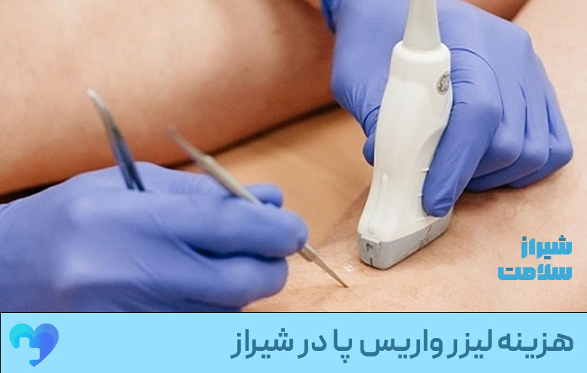هزینه لیزر واریس پا در شیراز هزینه لیزر واریس پا در شیراز