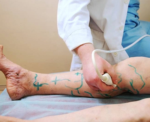 هزینه لیزر واریس پا در شیراز