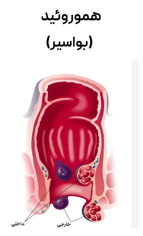 لیزر هموروئید در شیراز با متد 2026 با بهترین دکتر لیزر هموروئید در شیراز