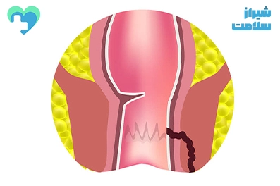 لیزر فیستول در شیراز با بهترین دکتر لیزر فیستول در شیراز درمان فیستول در شیراز