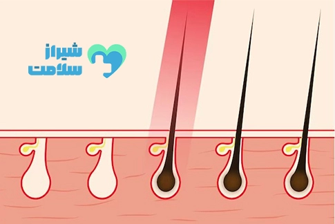 لیزر کیست مویی در شیراز