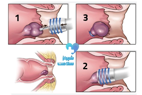 لیزر فیستول در شیراز با بهترین دکتر لیزر فیستول در شیراز هزینه عمل فیستول