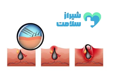 هزینه لیزر کیست مویی