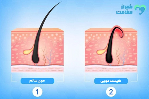 لیزر کیست مویی در شیراز با بهترین جراح کیست مویی