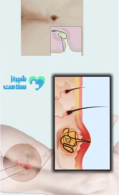 لیزر کیست مویی