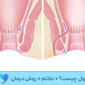 عمل فیستول چیست؟ + علائم + روش درمان
