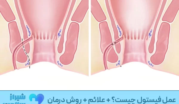 عمل فیستول چیست؟ + علائم + روش درمان