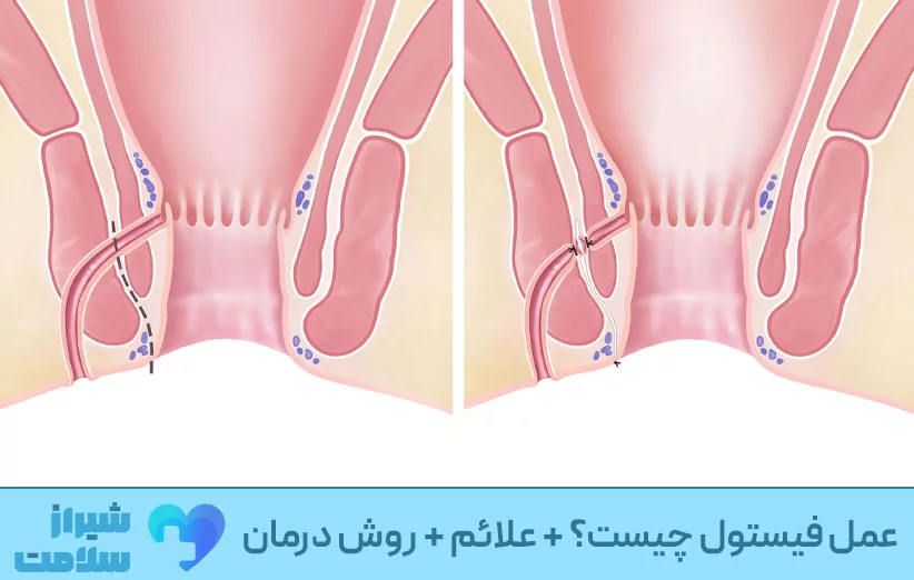 عمل فیستول چیست؟ + علائم + روش درمان عمل فیستول چیست؟ + علائم + روش درمان
