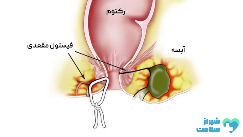 عمل فیستول چیست؟ + علائم + روش درمان فیستول مقعدی