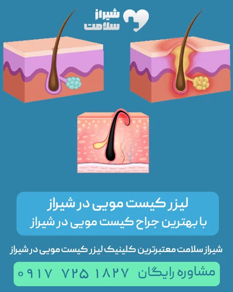 لیزر کیست مویی در شیراز