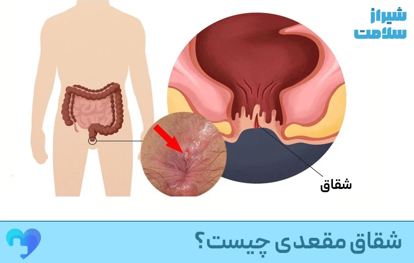 شقاق مقعد چیست؟ شقاق چیست
