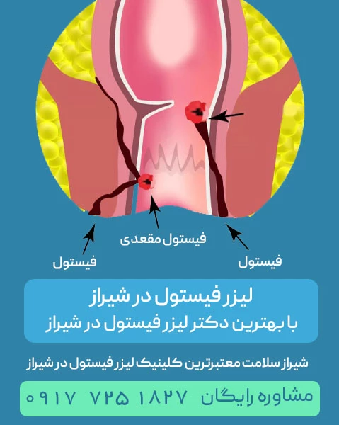 لیزر فیستول در شیراز با بهترین دکتر لیزر فیستول در شیراز