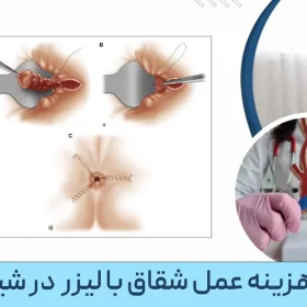 هزینه عمل شقاق با لیزر در شیراز