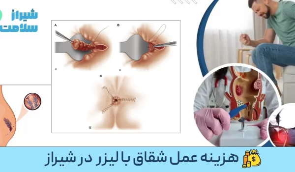 هزینه عمل شقاق با لیزر در شیراز هزینه عمل شقاق با لیزر در شیراز