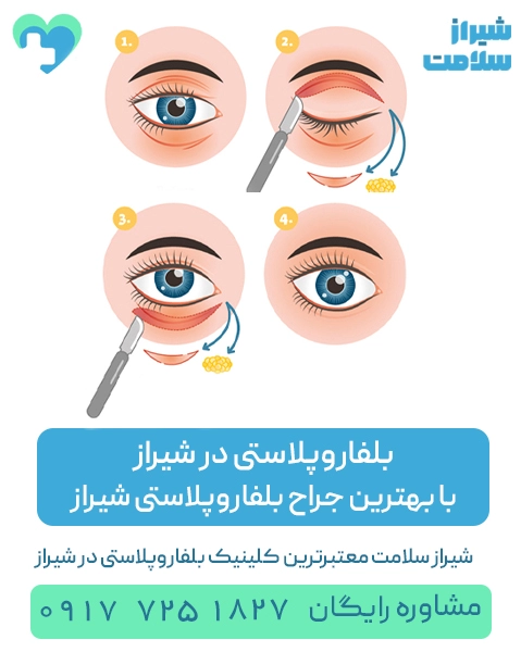 بلفاروپلاستی_شیراز_با_بهترین_جراح_بلفاروپلاستی_شیراز