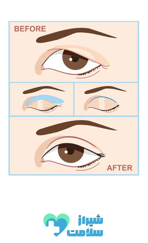 بهترین_کلینیک_بلفاروپلاستی_در_شیراز