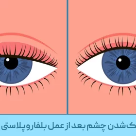 علت_کوچک‌شدن_چشم_بعد_از_عمل_بلفاروپلاستی