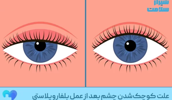 علت_کوچک‌شدن_چشم_بعد_از_عمل_بلفاروپلاستی