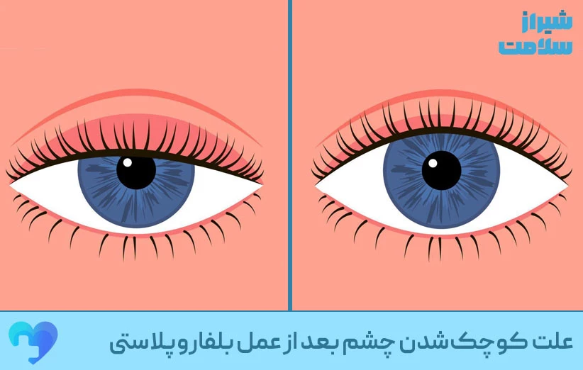 علت_کوچک‌شدن_چشم_بعد_از_عمل_بلفاروپلاستی