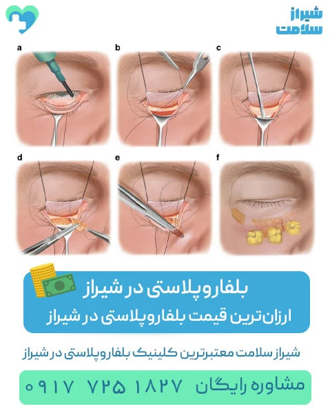 قیمت بلفاروپلاستی در شیراز