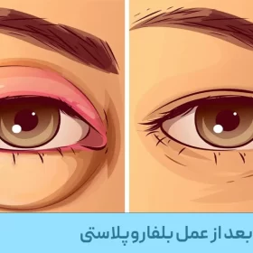 ورم پلک بعد از عمل بلفاروپلاستی