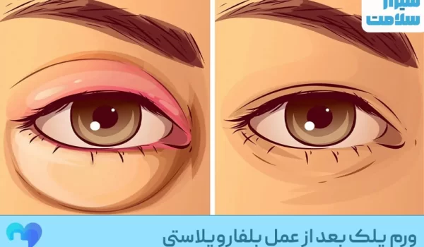 ورم پلک بعد از عمل بلفاروپلاستی