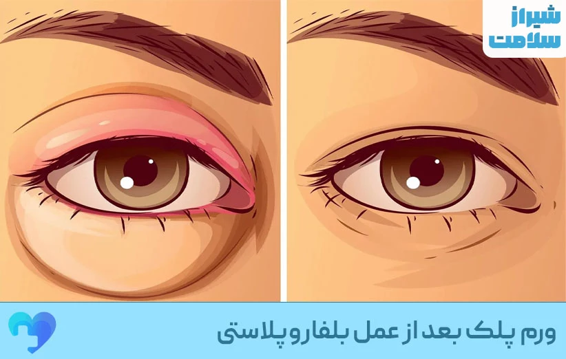 ورم پلک بعد از عمل بلفاروپلاستی