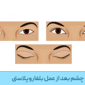 باز_ماندن_چشم_بعد_از_عمل_بلفاروپلاستی
