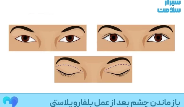 باز_ماندن_چشم_بعد_از_عمل_بلفاروپلاستی