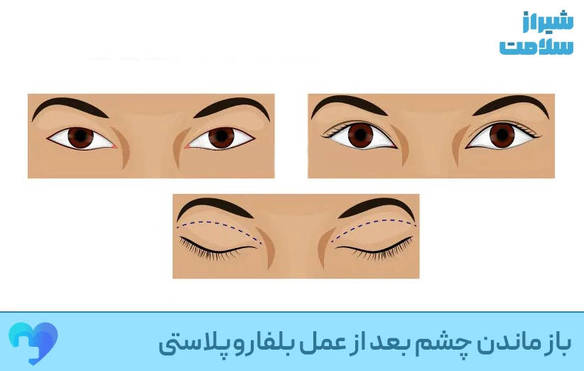باز_ماندن_چشم_بعد_از_عمل_بلفاروپلاستی