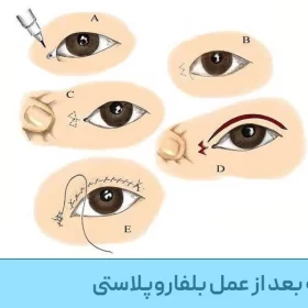جای بخیه بعد از عمل بلفاروپلاستی