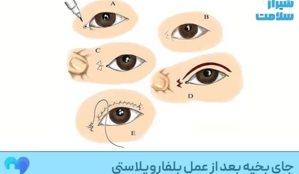 جای بخیه بعد از عمل بلفاروپلاستی