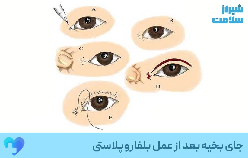 جای بخیه بعد از عمل بلفاروپلاستی