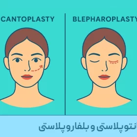تفاوت_کانتوپلاستی_و_بلفاروپلاستی