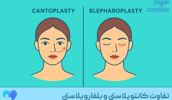 تفاوت_کانتوپلاستی_و_بلفاروپلاستی