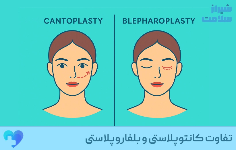 تفاوت_کانتوپلاستی_و_بلفاروپلاستی